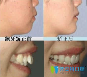 開立特口腔網(wǎng)站齙牙矯正前后對比圖