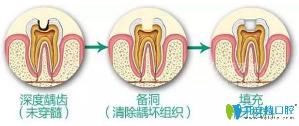 在上海拜博補牙多少錢 補牙用什么材料好/價格上相差多嗎