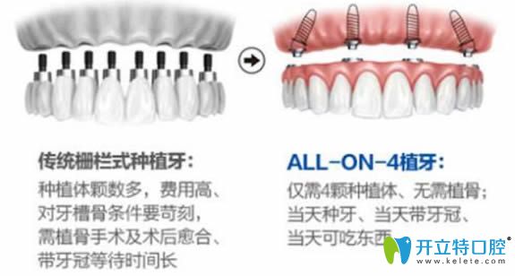 全口種植牙的價(jià)格需要多少錢,有allon4/6即刻種植牙費(fèi)用詳情
