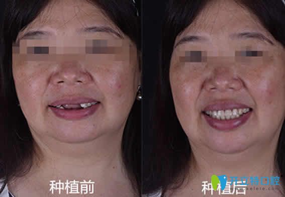 無(wú)錫通善口腔王杏松多顆牙種植案例效果圖