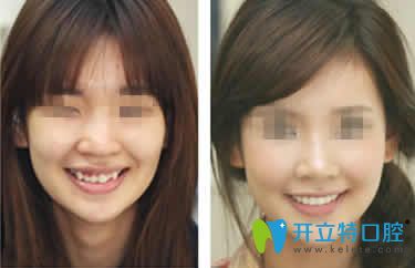 無(wú)錫通善口腔趙超醫(yī)生隱形牙齒矯正案例效果圖