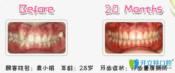 沈陽(yáng)歡樂(lè)口腔隱適美矯正案例