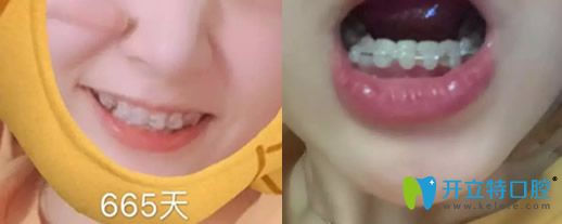 去沈陽(yáng)歡樂(lè)口腔做牙齒半隱形矯正665天變化圖