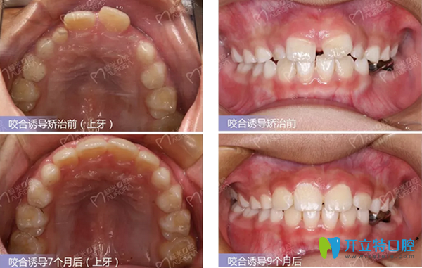成都極光口腔正畸效果案例