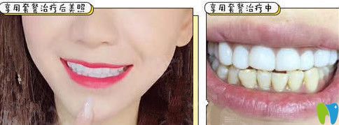 <!--<i data=20240703-sp></i>-->口腔皓齒美白治療前后對(duì)比案例