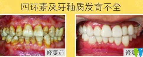維樂口腔牙齒瓷貼面治療前后對(duì)比案例