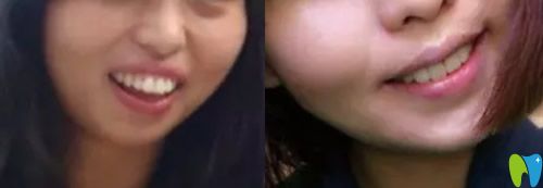 重慶牙科哪家好，看美維口腔齙牙矯正案例效果圖