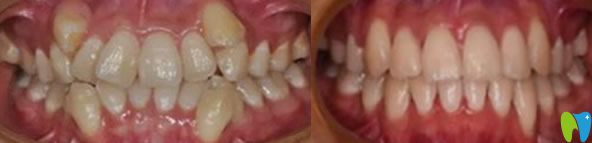美麗雅口腔牙齒正畸代表案例