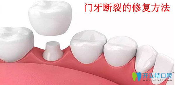 美麗雅口腔門牙斷裂的修復方法