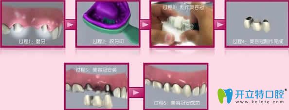 新技術分享：牙齒美容冠怎么做及美容冠前后對比照片