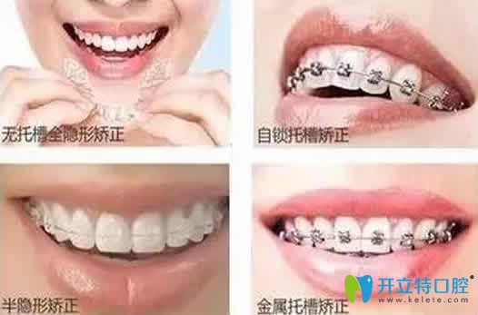 成年人牙齒矯正的方法