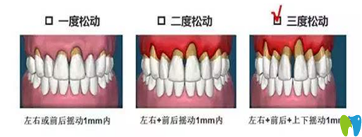 牙齒松動治療辦法和松動程度有關(guān)