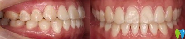 大連美麗雅口腔隱形牙齒矯正術(shù)后效果圖