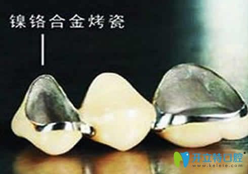 鎳鉻烤瓷牙圖片