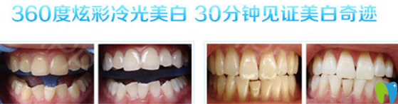 福州哪家牙科好？看貝臣齒科冷光美白案例來(lái)證明