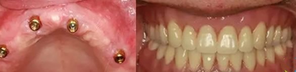 誰(shuí)說(shuō)牙齦萎縮不能種牙 來(lái)看上海雅悅齒科種植牙效果怎么樣