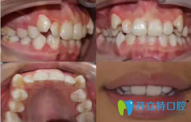 我在寧波壹加壹口腔找茅來發(fā)主任做牙齒正畸的體驗(yàn)分享