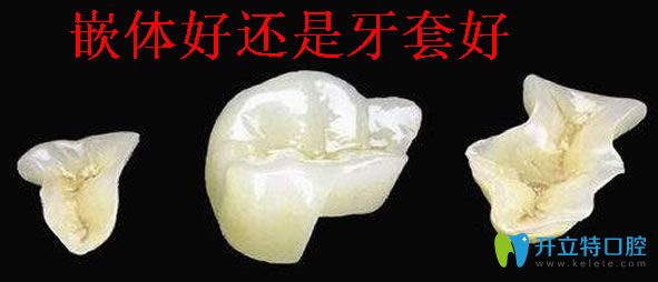 牙齒嵌體和牙套那個好 分享嵌體補牙能維持多久及修復(fù)價格