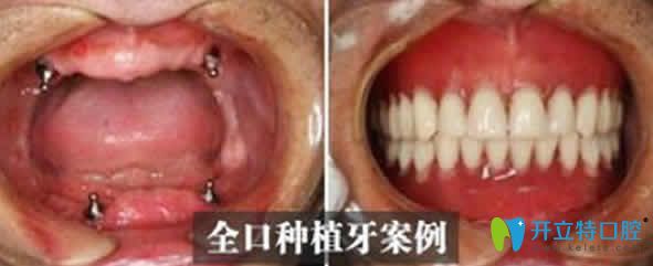 <!--<i data=20240703-sp></i>-->口腔全口種植牙案例對比圖