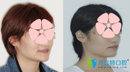 天津英瑞齒科怎么樣，地包天矯正案例來驗(yàn)證