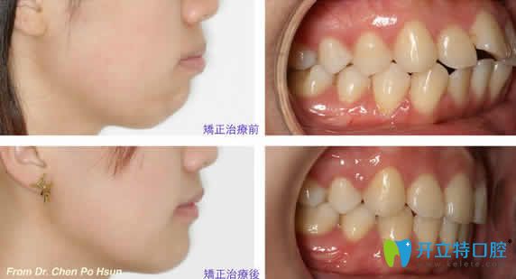 ?？趪趴谇环鶓c醫(yī)生隱形牙齒矯正案例效果圖