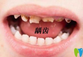兒童齲齒影響換牙嗎?牙科醫(yī)生告訴你預(yù)防齲齒的方法有哪些
