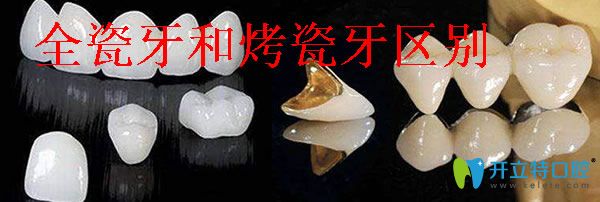 烤瓷牙和全瓷牙哪個好 分享全瓷牙和烤瓷牙之間有什么區(qū)別