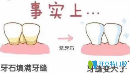 開立特口腔網(wǎng)：洗牙會導(dǎo)致牙縫變大嗎？