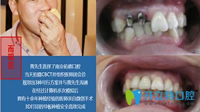 南京佑德口腔活力親水種植牙過程舒適高效的新體驗(yàn)