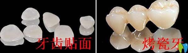 烤瓷牙好還是牙齒貼面好，區(qū)別是什么？具體答案都在這里