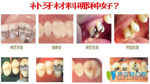 補(bǔ)牙材料哪種好
