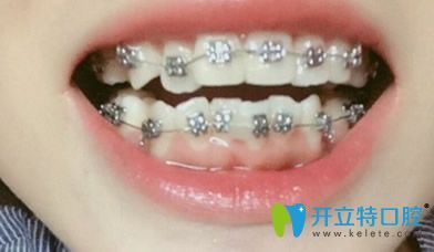 在武漢第 一口腔醫(yī)院做牙齒正畸前圖片
