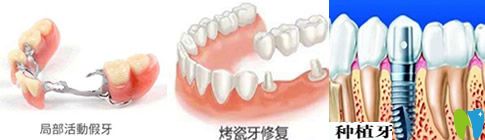 種植牙、活動假牙和烤瓷牙哪個好？看完你就會明白哦