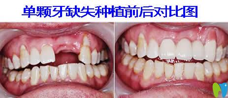 天津愛(ài)齒口腔種植牙案例效果圖