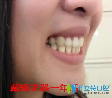 我在天津愛(ài)齒口腔做牙齒矯正一年效果照片
