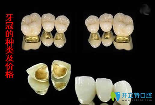 牙冠的種類及價(jià)格