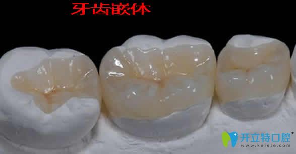 牙齒嵌體