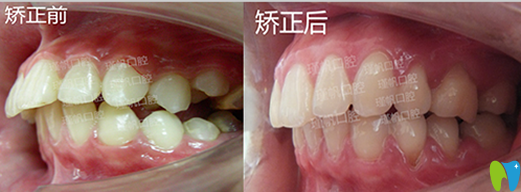 桂林瑾帆口腔好不好？真人牙齒矯正案例及術(shù)后反饋來驗證