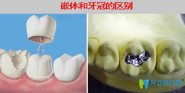 專業(yè)醫(yī)生講解牙齒做嵌體和牙冠哪個好？區(qū)別在哪里