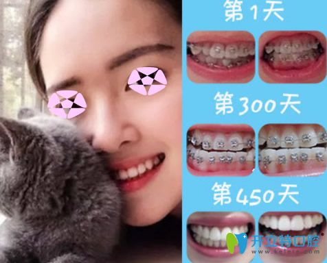 成人矯正牙齒效果好嗎？看上海伊爾意口腔正畸前后對(duì)比圖