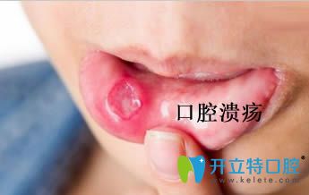 開立特引起復(fù)發(fā)性口腔潰瘍?cè)蚴鞘裁? border=