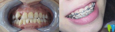 北京誠之康口腔正畸怎么樣？來看對比圖