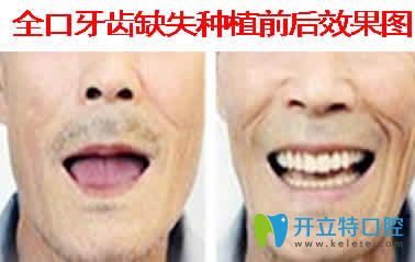 北京美冠塔口腔方雅紅全口種植牙效果圖