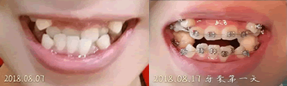 在誠之康口腔拔了四顆牙以及帶上牙套天