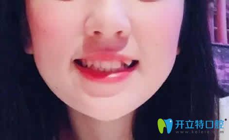 透露我在廈門天使口腔做虎牙矯正前后對比照片及親身經歷