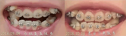 我在誠之康口腔牙齒矯正一個月效果圖