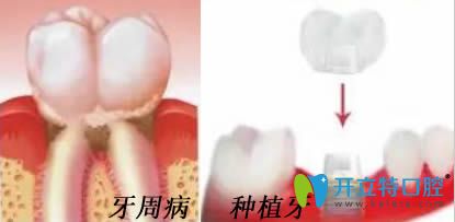 杭州植得口腔解析牙周病于種植牙的危害