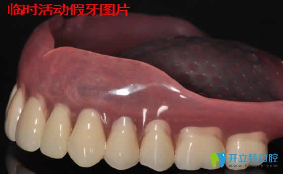 臨時(shí)活動假牙能戴多久？資深牙醫(yī)分享戴臨時(shí)假牙注意事項(xiàng)