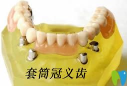 詳解什么是套筒冠義齒,以及套筒冠假牙的優(yōu)缺點和制作過程