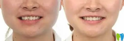 牙齒擁擠矯正案例及前后對比照